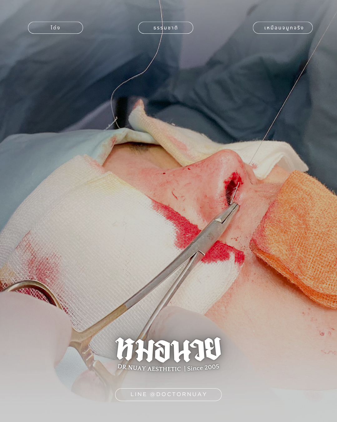 ศัลยกรรมจมูก